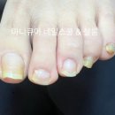노가(NOGA)네일&뷰티 | 발톱무좀 발톱각화증 병원치료 네일샵관리