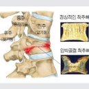 골다공증 수치 약 주사 검사 / 골밀도 정상수치 이하 골감소증 이라면 주의 이미지