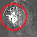남수동 11-709 ~ 남수동 11-93 | Case_Study_535:유방에 덩어리가 만져져서 내원한 48세 여성_유방의 선편평세포암(Adenosquamous...