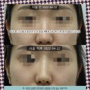 실과 바늘 | 대전 필러 후기 코필러잘하는곳 진짜일까? 제대로 된 기준 찾는 법(의사작성)