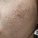 유일한한의원 | 얼굴흉터 피부과한의원 새살 채운 후기