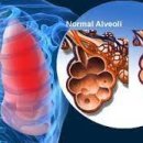 급성 호흡곤란 증후군[acute respiratory distress syndrome, ARDS] 이미지