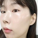 천안피부과 볼뉴머 리프팅 효과 통증 리얼후기