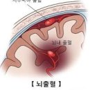 뇌출혈 전조증상 골든타임 후유증 뇌출혈 원인 이미지