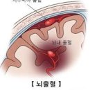 뇌출혈 원인 및 후유증 알아 두세요 이미지