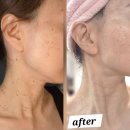 삼성의원 | 삼성의원 편평사마귀 제거 두달 후기