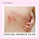 나헌식한의원 | 두드러기 원인, 나헌식 한의원 후기 피부과에서 못 고친 이유