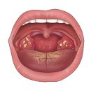 편도선염(Tonsillitis) 이란.. 이미지