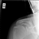 Shoulder_ap_joint_impingemnt_sydrome_greater_tuberosity 이미지