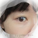 멍이와 양이 | 인천 송도 틴들현상 눈밑필러제거 녹이기 후기