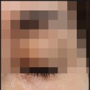 규림한의원 | 눈밑 한관종 고민 끝! 노원한관종 규림 한의원 방문 후기