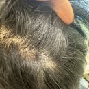 케어마트 | 화정미용실 이철헤어커커 롯데마트 화정점 두피케어 크리닉 후기