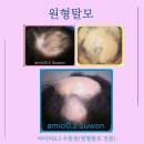 두피 탈모 아미치 0.3 수원점 이미지