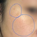 혁신1로 | 김천 구미 피부관리 잡티 주근깨 흑자 제거 진앤뷰티 5회차 후기