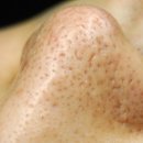 호산한의원 | [공지] 피지가 빠진 깊은 코모공흉터