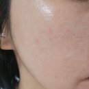 브이 | 압구정 피부과레이저 잡티제거 피코슈어 엑셀브이 후기