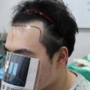 멋진남성의원 | 전두부까지..." 20대 남자 비절개 모발이식 3000모, 확실한 밀도 보강이 정답인 이유 - 압구정 모더함의원-