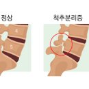 척추분리증 증상 통증 원인과 치료 운동방법 이미지