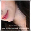 에이트성형외과의원 | 슈링크 리프팅 후기 효과? 부작용 예방법 에이트성형외과 피부과