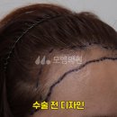 중앙헤어라인 이미지