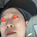 경재치과기계상사 | 부산 비립종 편평사마귀 뽑은 후기요