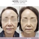 대덕대로-1 | 대전 실리프팅 후기 : 수술 없이 또렷한 페이스라인 완성