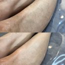 광주 수완지구 왁싱 반바지 입는 날씨 대비 종아리 왁싱 후기 그리다수