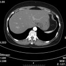 hcc ? - ＞ hemangioma 이미지