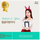 이지미의원 | 얼굴지방이식전후 송도성형외과 지방흡입 솔직후기