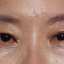 정웅기성형외과 | [공지] 압구정역 정웅기성형외과 전후 후기 사진 모음