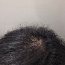 다모 | 다모케어정 피나스테리드 탈모약 부작용 후기