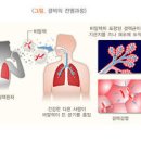 폐결핵 결핵 원인 전염 예방 이미지