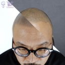 탈모왕