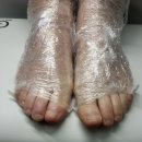 연세마디의원 | 효도다! 어머니와 함께 치료받은 솔직후기 – 발톱무좀, 스케일링, 오니코레이저까지 부천연세튼튼의원
