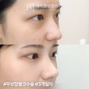 하모니성형외과의원 | [송도성형외과] 코재수술/첫수술 모두 '무보형물'로! 염증, 구축 걱정 끝내는 법 (리미트 코성형)