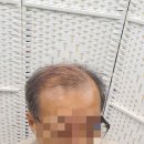김호증모가발by헤어리서치