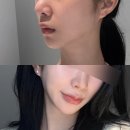 강남역11번출구 스킨보톡스 , 강남역피부과 스킨보톡스 후기 토끼굴