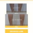 혈관염 자반증, 자꾸 반복해서 재발한다면 어떤 치료 받아야할까? -17년차 한의사 작성