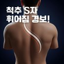 척추측만증, 척추가 왜 옆으로 휘어질까? 송파사랑정형외과
