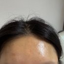 새대구한의원 | 대구 덕산동 교통사교 흉터 치료 한의원 리얼 후기 1회차 (전/후사진있음)