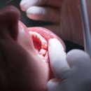 서울J플란트치과의원 네이버블로그
