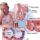 폐에 물이 차는 이유와 물이 차면 나타나는 증상 : 폐부종 이미지