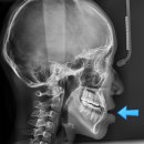 보가치과의원 | 주걱턱 교정 비용 500만 원 날림