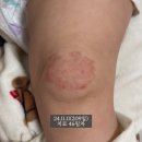 이석종피부과의원 | 대구 혈관종 피부과/ 이석종 피부과/ 4차 레이저 치료 과정 + 다섯번째 진료 기록