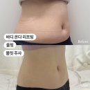 압구정로데오 복부지방분해주사 후기｜볼릿주사 + 바디온다 효과 및 멍