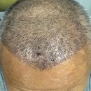 월차 | 터키 모발이식 후 2개월차된 후기 이야기 (튀르키예 모발이식)