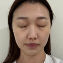 다시봄날 | [오송피부과] 오송 다시봄날의원 가성비 리프팅시술 인모드 슈링크 300샷 후기