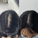 하루비어 | 부산가르마탈모 후기, 비어있는 곳? 이젠 안 보여요