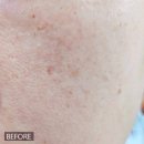 고운피부과의원 | 대전 둔산 탄방동 피코토닝 강남언니 앱결제로 다녀온 피부과 의원 시술 리얼후기