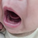 서울바로치과의원 | [서울바로치과의원 인천검단점]내돈내산 3개월아기 진료 진주종?치아?